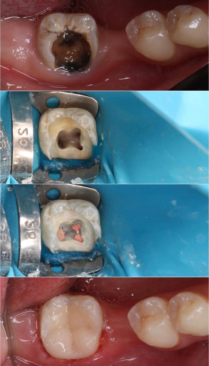 Dental cosmetic work by Dr. Ahmed Elqadoum - Case 1