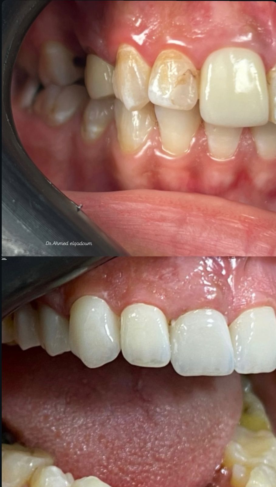 Teeth whitening result by Dr. Ahmed Elqadoum - Case 2