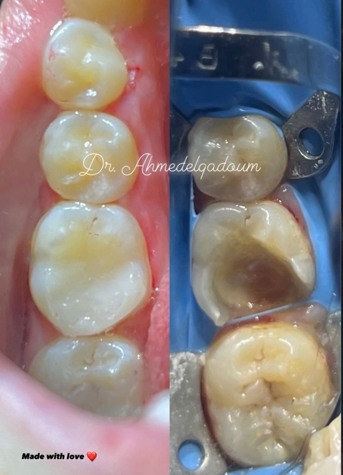 Dental implant procedure by Dr. Ahmed Elqadoum - Case 3